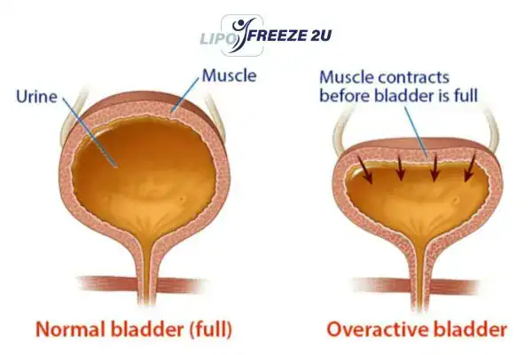 diagram of overactive bladder treatment Waltham Abbey