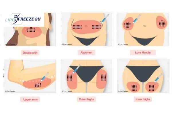 Benefits of Choosing Aqualyx for Fat Reduction Waltham Abbey