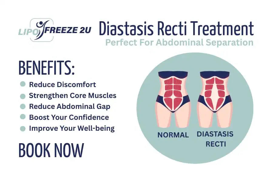 Benefits of body toning treatment Waltham Abbey for Diastasis recti
