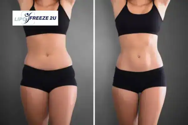 How Can LIPO FREEZE 2U Support Your Post-Pregnancy Body Recovery Waltham Abbey?