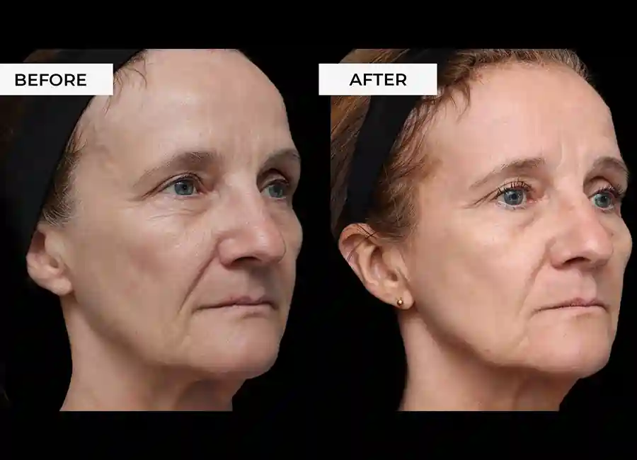 How Many RF Microneedling Sessions Will You Need to See a Difference Waltham Abbey?