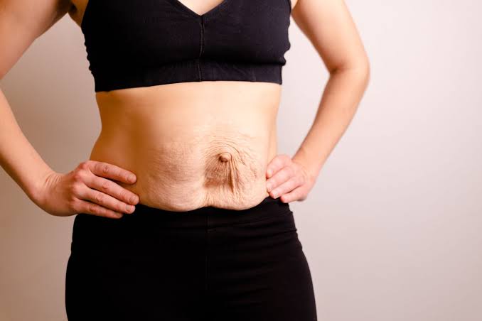 Is Surgery Really the Only Way to Repair Diastasis Recti Waltham Abbey?