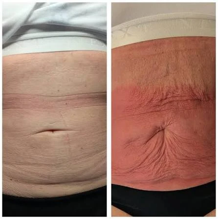How Does RF Microneedling Improve Crepey, Thin and Uneven Skin Texture Waltham Abbey?