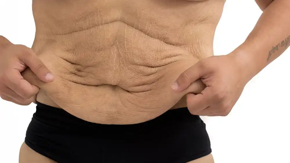 Why Does Weight Loss Medication Leave Some People With Loose or Sagging Skin Waltham Abbey?